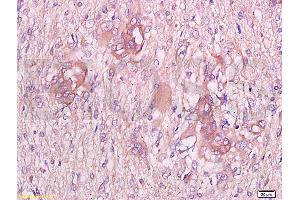 Formalin-fixed and paraffin embedded human endometrium carcinoma labeled with Anti-CGP-39/YKL-40 Polyclonal Antibody, Unconjugated at 1:300 followed by conjugation to the secondary antibody and DAB staining (CHI3L1 anticorps  (AA 330-381))