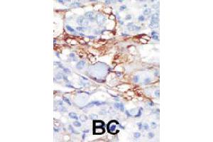 Formalin-fixed and paraffin-embedded human cancer tissue reacted with PDGFRL polyclonal antibody  , which was peroxidase-conjugated to the secondary antibody, followed by DAB staining. (PDGFRL anticorps  (C-Term))