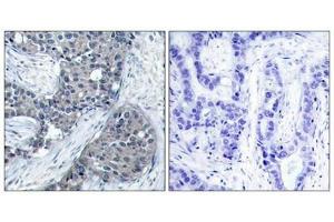 Immunohistochemical analysis of paraffin-embedded human breast carcinoma tissue using eIF4E(Phospho-Ser209) Antibody(left) or the same antibody preincubated with blocking peptide(right). (EIF4E anticorps  (pSer209))