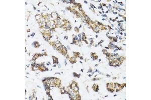 Immunohistochemistry of paraffin-embedded human breast cancer using DHRS2 antibody.