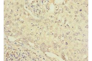 Immunohistochemistry of paraffin-embedded human lung cancer using ABIN7152656 at dilution of 1:100