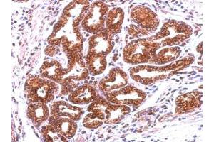 IHC-P Image Immunohistochemical analysis of paraffin-embedded human colon carcinoma, using Annexin A13, antibody at 1:500 dilution. (Annexin A13 anticorps  (N-Term))
