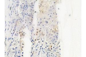 ABIN6263071 and ABIN6266879 at 1/100 staining human lung squamous cell carcinoma by IHC-P. (Melanoma Antigen Family D, 4 (MAGED4) (C-Term) anticorps)