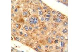 AMACR antibody immunohistochemistry analysis in formalin fixed and paraffin embedded human hepatocarcinoma.