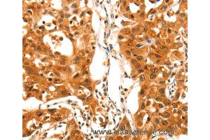 Immunohistochemistry of Human lung cancer using SERPINB5 Polyclonal Antibody at dilution of 1:60 (SERPINB5 anticorps)