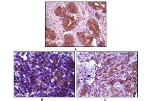 Immunohistochemical analysis of paraffin-embedded human breast tissue (A), lymph tissue (B) and skin carcinoma (C), showing membrane localization using BLK antibody with DAB staining. (BLK anticorps)