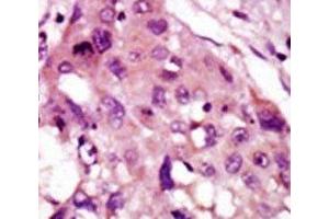 IHC analysis of FFPE human hepatocarcinoma tissue stained with the IRAK2 antibody