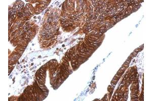 IHC-P Image Thrombomodulin antibody [C3], C-term detects THBD protein at cytosol and membrane on human gastric cancer by immunohistochemical analysis. (Thrombomodulin anticorps  (C-Term))