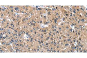 Immunohistochemistry of paraffin-embedded Human liver cancer tissue using DSC1 Polyclonal Antibody at dilution 1:40