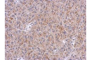 IHC-P Image Immunohistochemical analysis of paraffin-embedded Mahlarvu xenograft, using ALDH7A1, antibody at 1:500 dilution.