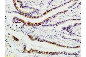 Formalin-fixed and paraffin-embedded : human colon carcinoma labeled with Rabbit Anti-Integrin αVβ1 Polyclonal Antibody , Unconjugated 1:200 followed by conjugation to the secondary antibody and DAB staining (ITGAV/ITGB1 anticorps)