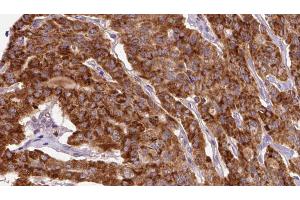 ABIN6267134 at 1/100 staining Human thyroid cancer tissue by IHC-P. (LCP1 anticorps  (pTyr28))