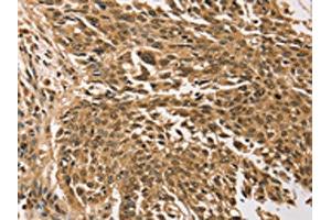The image on the left is immunohistochemistry of paraffin-embedded Human lung cancer tissue using ABIN7192784(TGM7 Antibody) at dilution 1/30, on the right is treated with synthetic peptide. (Transglutaminase 7 anticorps)