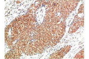 Immunohistochemical analysis of paraffin-embedded Human Breast Carcinoma Tissue using ATM Mouse mAb diluted at 1:200. (ATM anticorps)