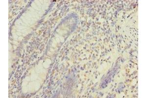 Immunohistochemistry of paraffin-embedded human colon cancer using ABIN7159710 at dilution of 1:100 (MFAP3L anticorps  (AA 29-102))