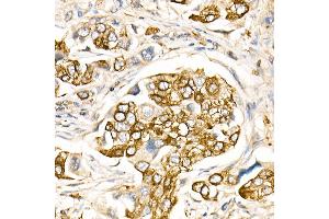 Immunohistochemistry of paraffin-embedded Human lung cancer using FasLG antibody (ABIN3020741, ABIN3020742, ABIN3020743, ABIN1512897 and ABIN6213701) at dilution of 1:150 (40x lens). (FASL anticorps  (AA 100-200))