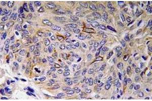 Immunohistochemistry (IHC) analyzes of IL-32 antibody in paraffin-embedded human lung carcinoma tissue. (IL32 anticorps)