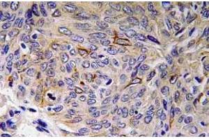 Immunohistochemistry (IHC) analyzes of IL-32 antibody in paraffin-embedded human lung carcinoma tissue.