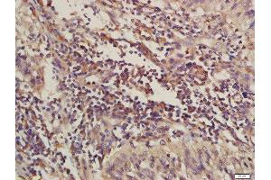 Formalin-fixed and paraffin embedded human laryngeal carcinoma labeled with Rabbit Anti-C4orf21 Polyclonal Antibody, Unconjugated (ABIN1714408) at 1:200 followed by conjugation to the secondary antibody and DAB staining (ZGRF1 anticorps  (AA 101-200))