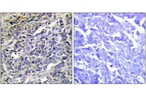 Immunohistochemistry analysis of paraffin-embedded human lung carcinoma tissue, using GRAK Antibody. (GZMK anticorps  (AA 61-110))