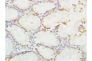 Formalin-fixed and paraffin embedded human gastric carcinoma labeled with Anti-phospho-YES1(Tyr426) Polyclonal Antibody, Unconjugated  at 1:200 followed by conjugation to the secondary antibody and DAB staining (YES1 anticorps  (pTyr426))