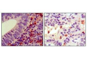 Immunohistochemical analysis of paraffin-embedded human colon cancer (left) and ancreas cancer (right), showing cytoplasmic localization using HCK antibody with DAB staining. (HCK anticorps)