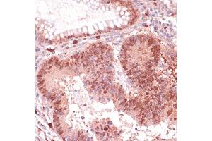Immunohistochemistry of paraffin-embedded human colon carcinoma using S100P antibody (ABIN7270133) at dilution of 1:100 (40x lens).