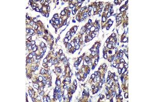 Immunohistochemistry of paraffin-embedded Human liver cancer using UGT1 Rabbit pAb (ABIN6132769, ABIN6149895, ABIN6149896 and ABIN6221779) at dilution of 1:100 (40x lens). (UGT1A1 anticorps  (AA 1-200))