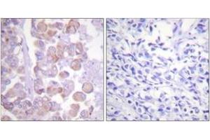 Immunohistochemistry analysis of paraffin-embedded human breast carcinoma tissue, using Synuclein (Ab-129) Antibody. (Synuclein anticorps  (AA 91-140))