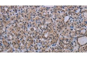 Immunohistochemistry of paraffin-embedded Human thyroid cancer tissue using MAGEC1 Polyclonal Antibody at dilution 1:30 (MAGEC1 anticorps)