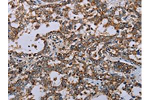 The image on the left is immunohistochemistry of paraffin-embedded Human liver cancer tissue using ABIN7191485(MMP23B Antibody) at dilution 1/20, on the right is treated with synthetic peptide. (MMP23A anticorps)