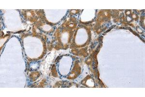 Immunohistochemistry of paraffin-embedded Human thyroid cancer using PPP2CA Polyclonal Antibody at dilution of 1:35 (PPP2CA anticorps)