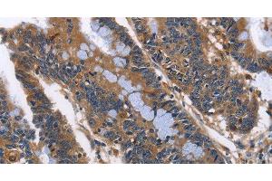 Immunohistochemistry of paraffin-embedded Human colon cancer using ILK Polyclonal Antibody at dilution of 1:50 (ILK anticorps)