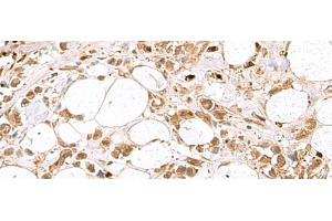 Immunohistochemistry of paraffin-embedded Human breast cancer tissue using RBFOX2 Polyclonal Antibody at dilution of 1:80(x200) (RBM9 anticorps)