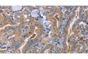 Immunohistochemistry of paraffin-embedded Human thyroid cancer using CD327 Polyclonal Antibody at dilution of 1:70