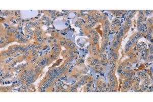 Immunohistochemistry of paraffin-embedded Human thyroid cancer using CD327 Polyclonal Antibody at dilution of 1:70 (SIGLEC6 anticorps)