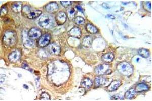 Immunohistochemistry (IHC) analyzes of c-RAF antibody in paraffin-embedded human breast carcinoma tissue. (RAF1 anticorps)