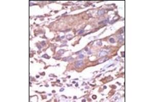 Formalin-fixed and paraffin-embedded human cancer tissue reacted with the primary antibody, which was peroxidase-conjugated to the secondary antibody, followed by AEC staining.
