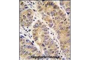 Formalin-fixed and paraffin-embedded human hepatocarcinoma tissue reacted with P13 antibody (C-term), which was peroxidase-conjugated to the secondary antibody, followed by DAB staining.