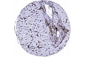 Liver Intense HLA DRB1 staining of inflammatory cells and of Kupffer cells HLA DRB1 immunohistochemistry (Recombinant HLA-DRB1 anticorps)