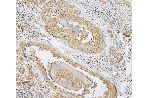 IHC analysis of IQGAP1 using anti-IQGAP1 antibody (ABIN6719262). (IQGAP1 anticorps)