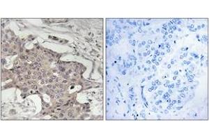 Immunohistochemistry analysis of paraffin-embedded human breast carcinoma tissue, using HIBADH Antibody. (HIBADH anticorps  (AA 281-330))
