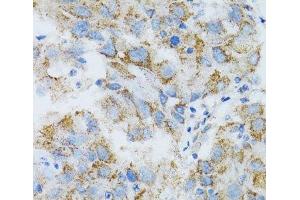 Immunohistochemistry of paraffin-embedded Human breast cancer using PSMD10 Polyclonal Antibody at dilution of 1:100 (40x lens). (PSMD10 anticorps)
