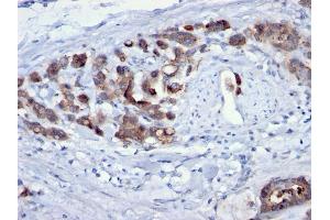 Formalin-fixed, paraffin-embedded human Gastric Carcinoma stained with CDC20 Mouse Monoclonal Antibody (AR12). (CDC20 anticorps)
