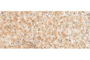 Immunohistochemistry of paraffin-embedded Human liver cancer tissue using ZNF185 Polyclonal Antibody at dilution of 1:25(x200) (Zinc Finger Protein 185 anticorps)