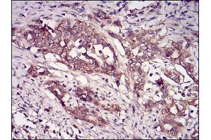 Immunohistochemical analysis of paraffin-embedded cervical cancer tissues using CSNK2B mouse mAb with DAB staining.