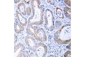 Immunohistochemical analysis of MKK1/2 (pS222/226) staining in human colon cancer formalin fixed paraffin embedded tissue section.