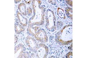 Immunohistochemical analysis of MKK1/2 (pS222/226) staining in human colon cancer formalin fixed paraffin embedded tissue section. (MEK1 anticorps  (pSer222, pSer226))