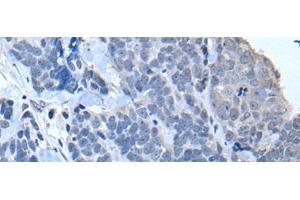 Immunohistochemistry of paraffin-embedded Human thyroid cancer tissue using TIA1 Polyclonal Antibody at dilution of 1:30(x200) (TIA1 anticorps)