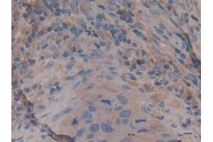 Detection of Rock2 in Human Lung cancer Tissue using Polyclonal Antibody to Rho Associated Coiled Coil Containing Protein Kinase 2 (Rock2)